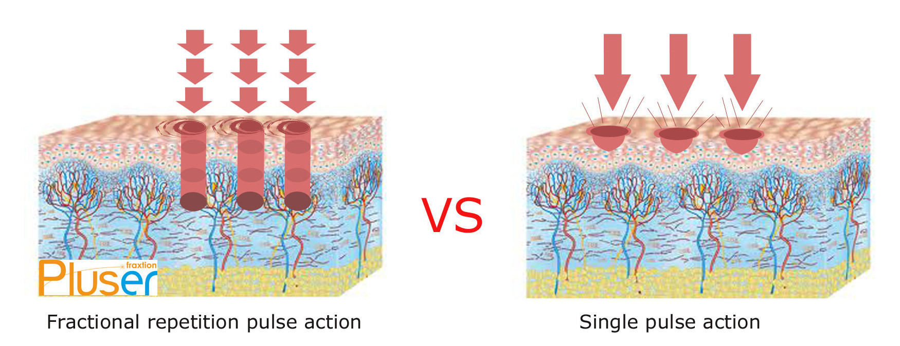 Pluser erbium laser fractional pulse
