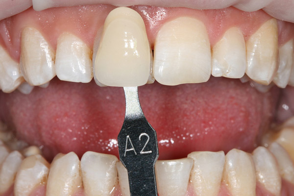 whitening01.jpg
