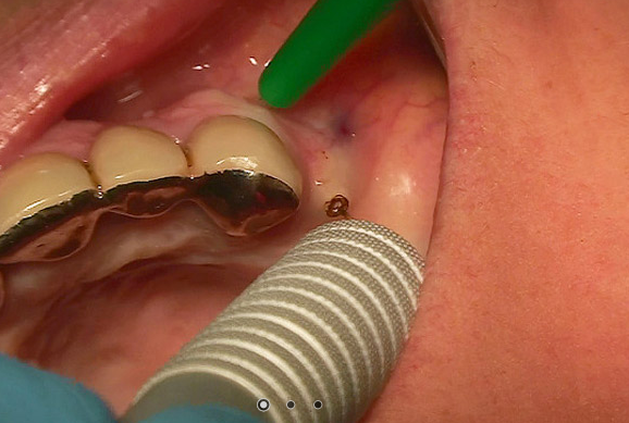 Implants