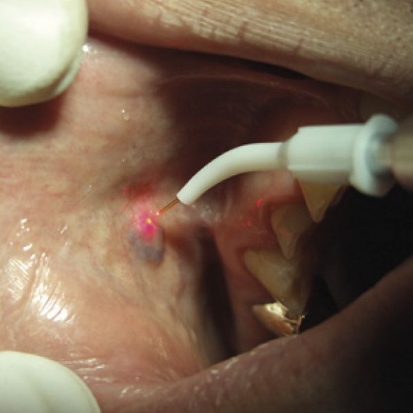 Emangiomi cavo orale 2