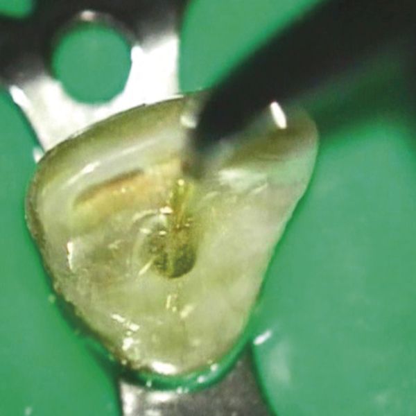 Endodonzia 2