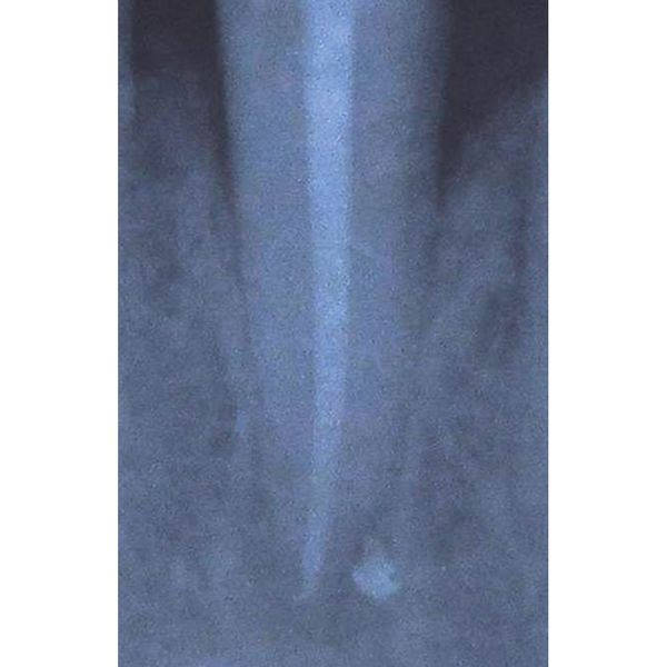 Endodonzia dopo