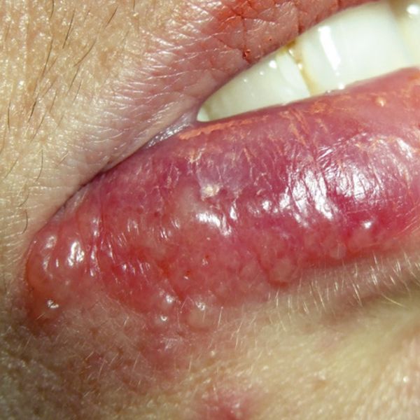 Herpes prima