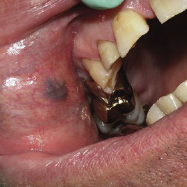 Emangiomi cavo orale prima