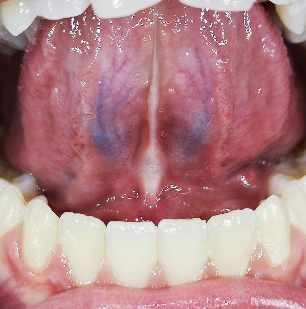 Laser dentali: Controllo a 7 giorni frenulectomia linguale