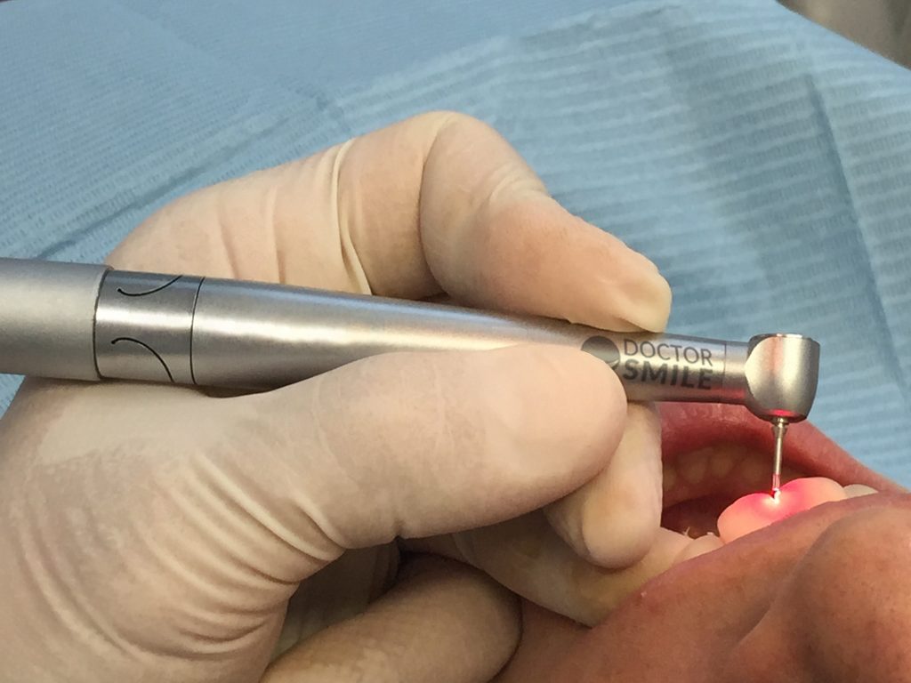laser in odontoiatria
