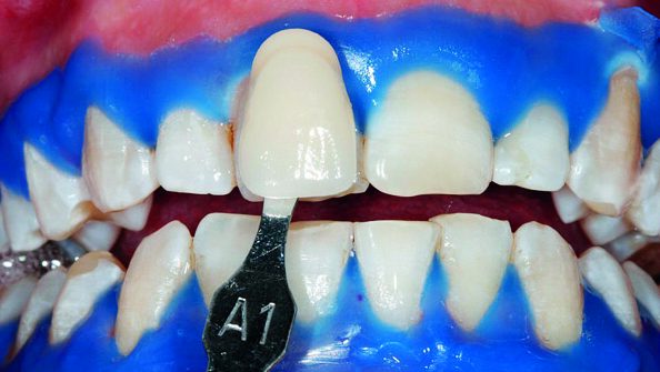 Risuntato di uno sbiancamento dentale con il laser