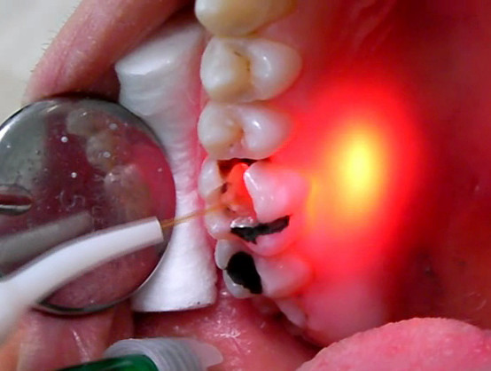 endodonzia laser